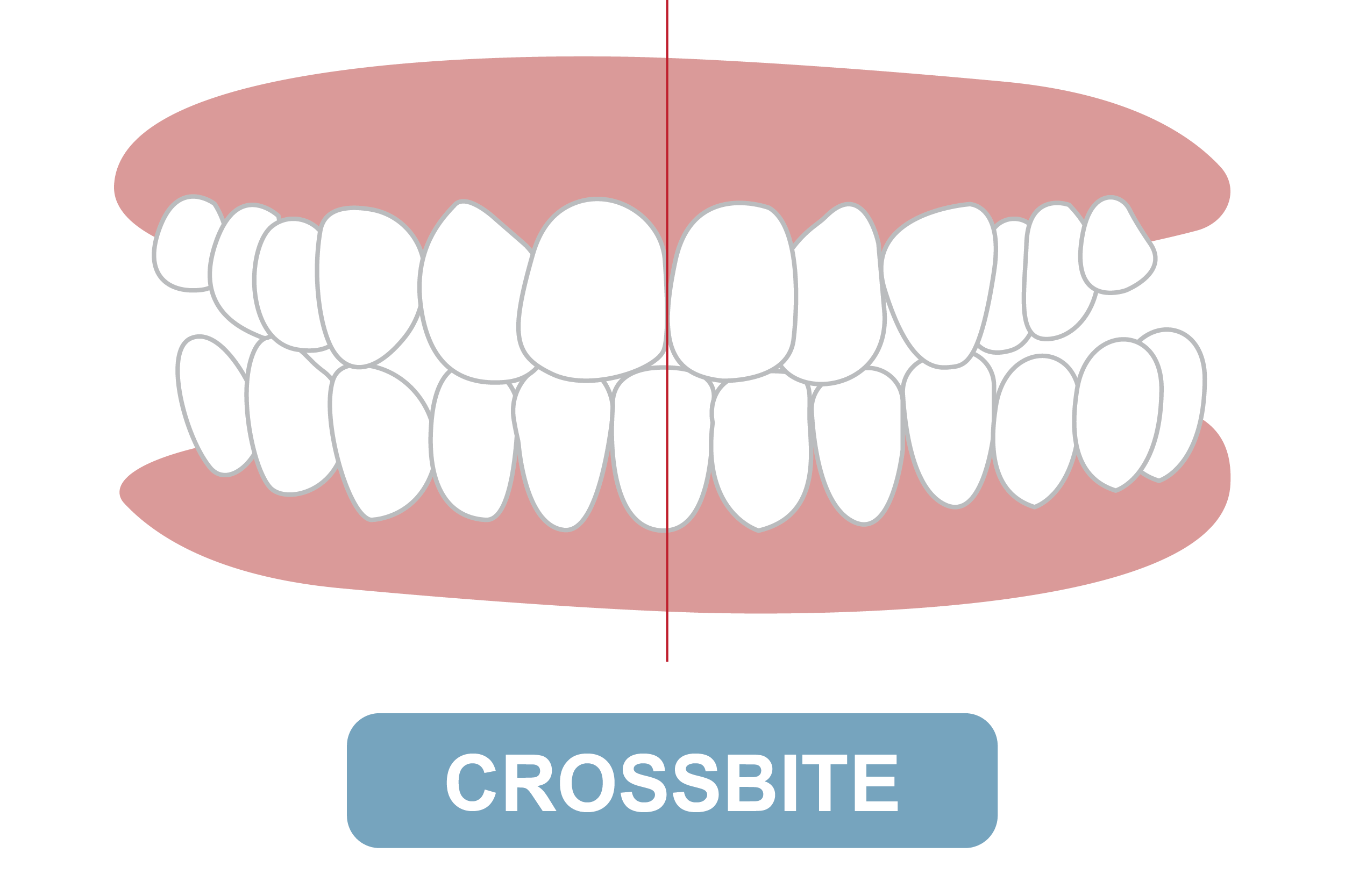 crossbite