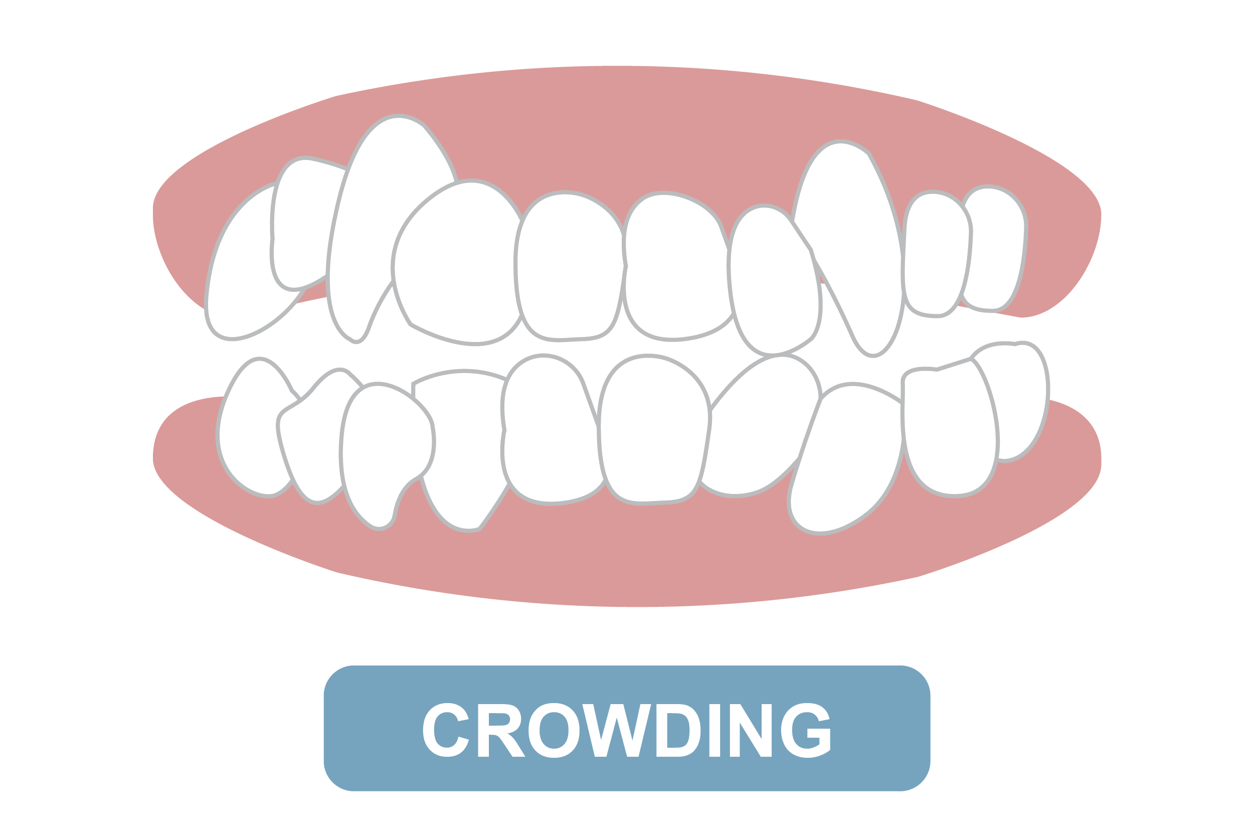 crowding