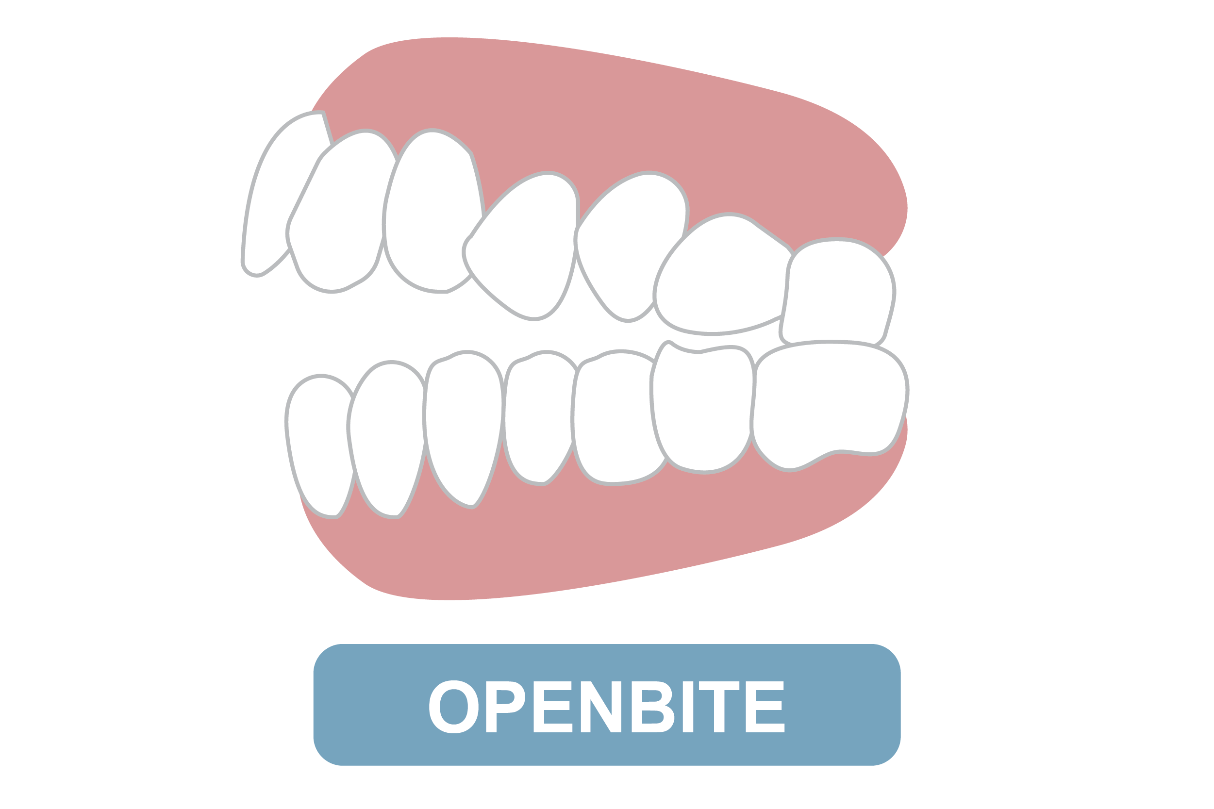 openbite