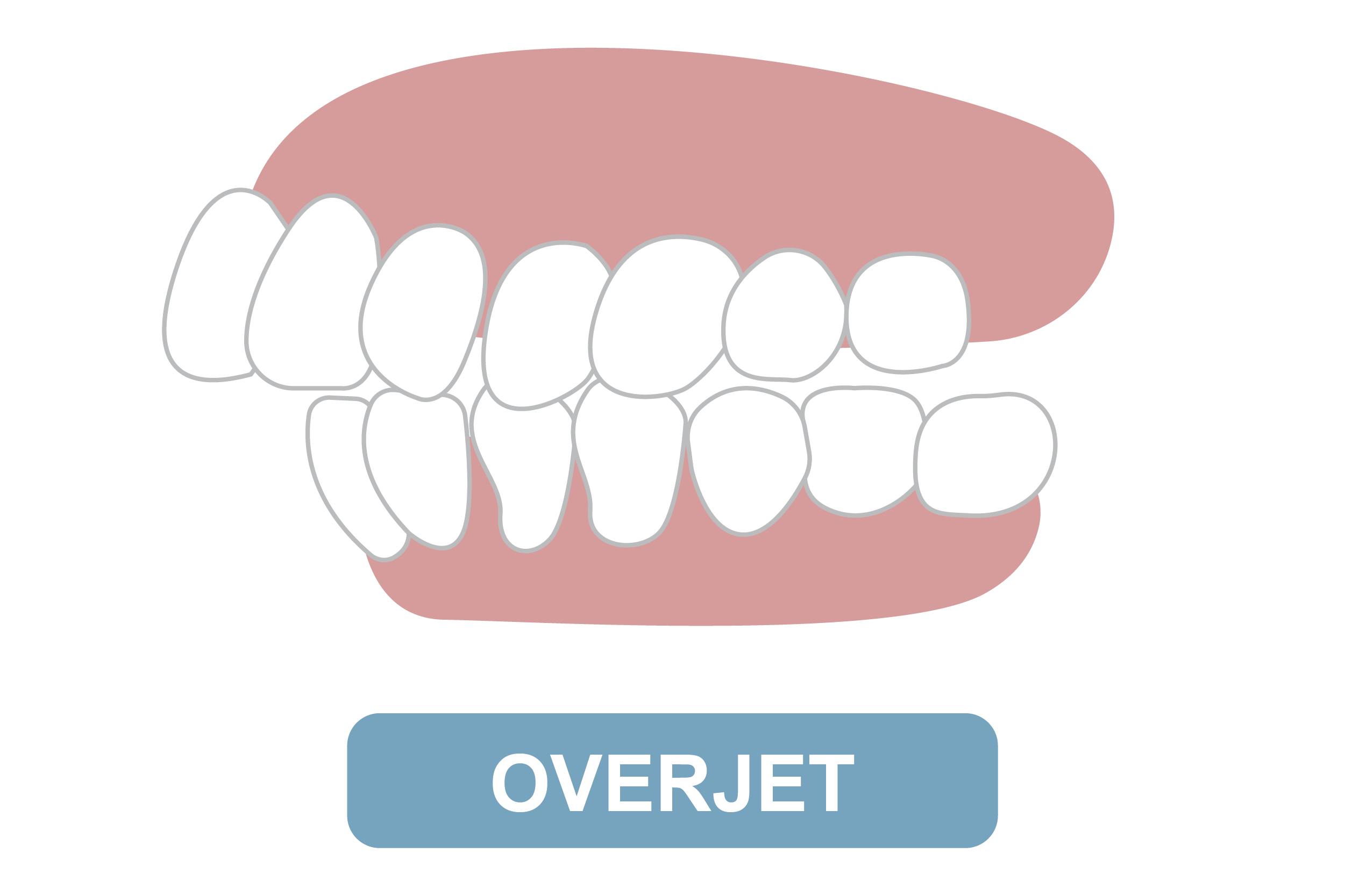 overjet