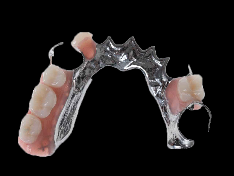 Partial Chrome cobalt lower denture with teeth with black background